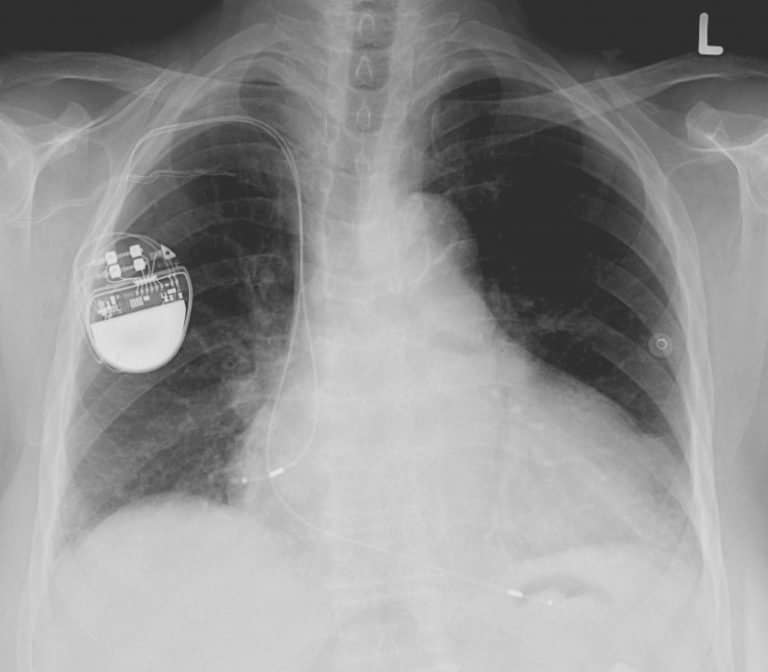 Pacemakers en insulinepompen kwetsbaar voor hacks